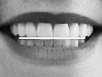 Perfect Smile horizontal alignment